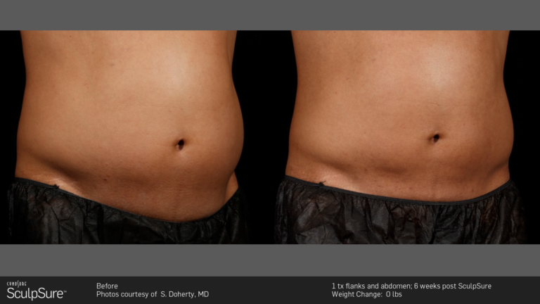 SculpSure Body Contouring Treatment - Dermatology Services In Boulder ...